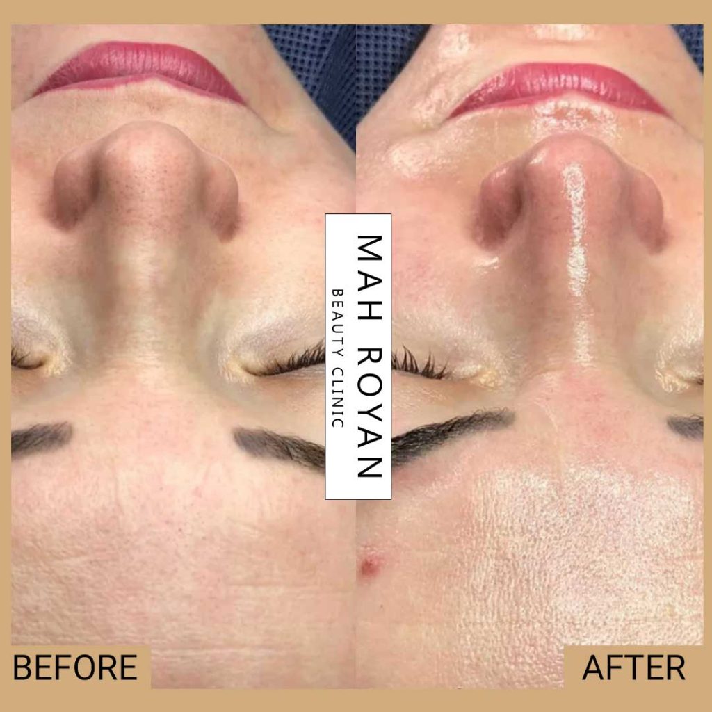 facial-before-after-01
