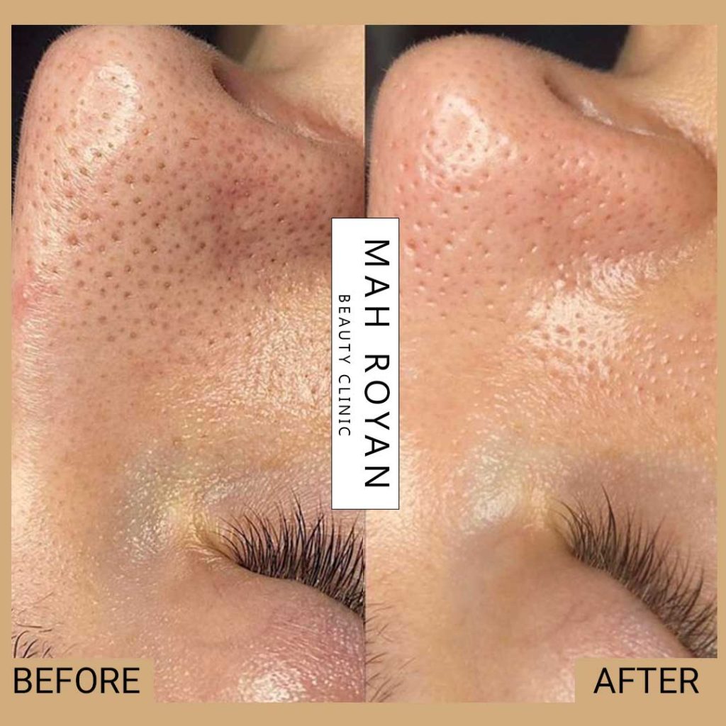 facial-before-after-02