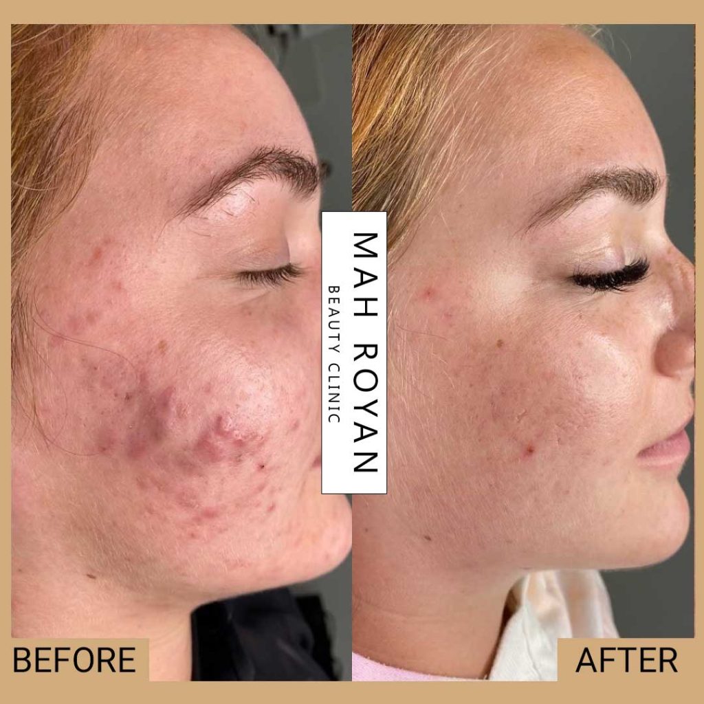 facial-before-after-03
