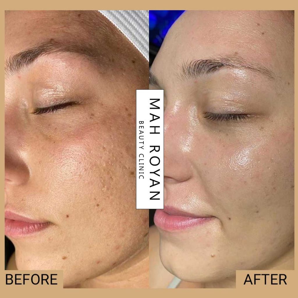 facial-before-after-04