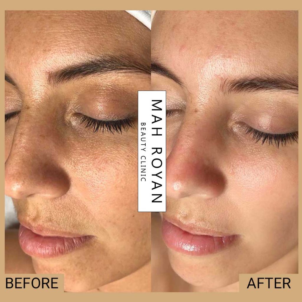facial-before-after-05