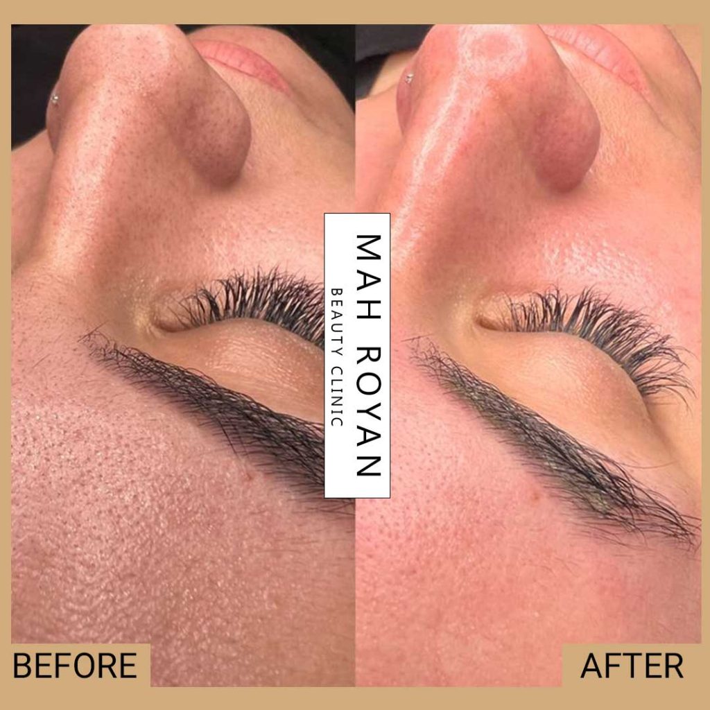 facial-before-after-06