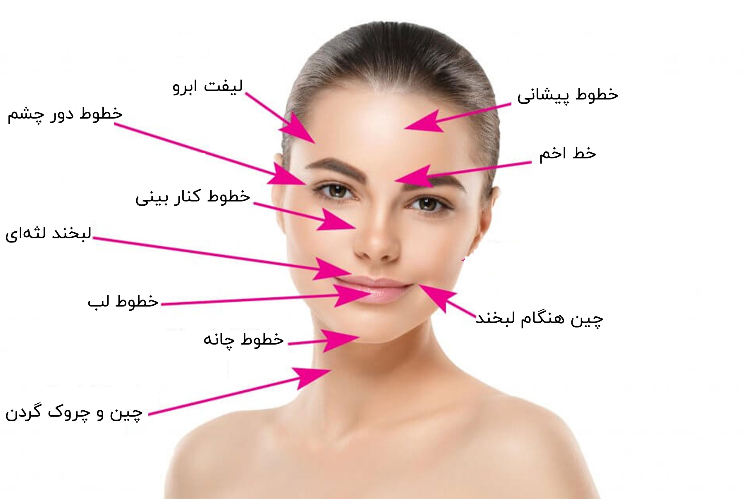 نقاط تزریق بوتاکس